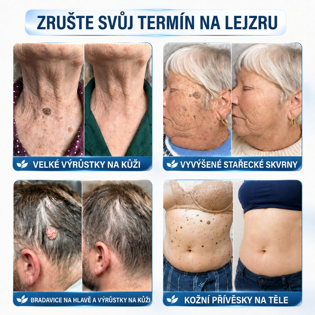 👩‍⚕️🎉 Oficiální obchod | MURWON® 👑 Mikrojehličkové náplasti pro dokonalou pleť a odstranění kožních nedokonalostí (Pro kožní výrůstky, malé kožní útvary, bradavice, mateřská znaménka, stařecké skvrny a pigmentové nepravidelnosti.)