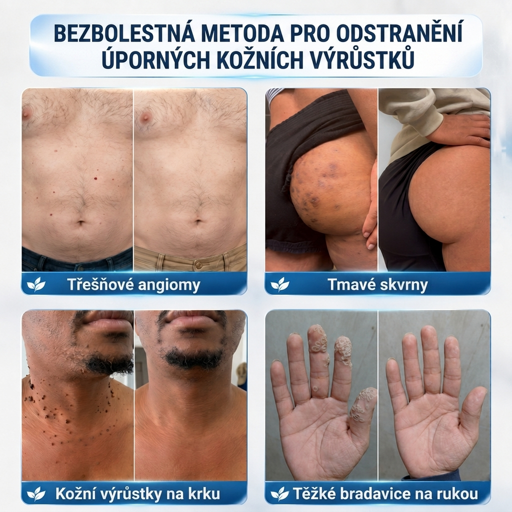 👩‍⚕️🎉 Oficiální obchod | MURWON® 👑 Mikrojehličkové náplasti pro dokonalou pleť a odstranění kožních nedokonalostí (Pro kožní výrůstky, malé kožní útvary, bradavice, mateřská znaménka, stařecké skvrny a pigmentové nepravidelnosti.)