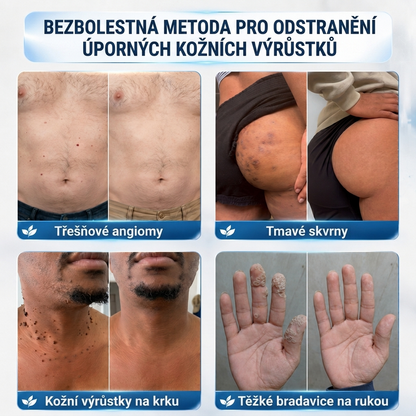 👩‍⚕️🎉 Oficiální obchod | MURWON® 👑 Mikrojehličkové náplasti pro dokonalou pleť a odstranění kožních nedokonalostí (Pro kožní výrůstky, malé kožní útvary, bradavice, mateřská znaménka, stařecké skvrny a pigmentové nepravidelnosti.)