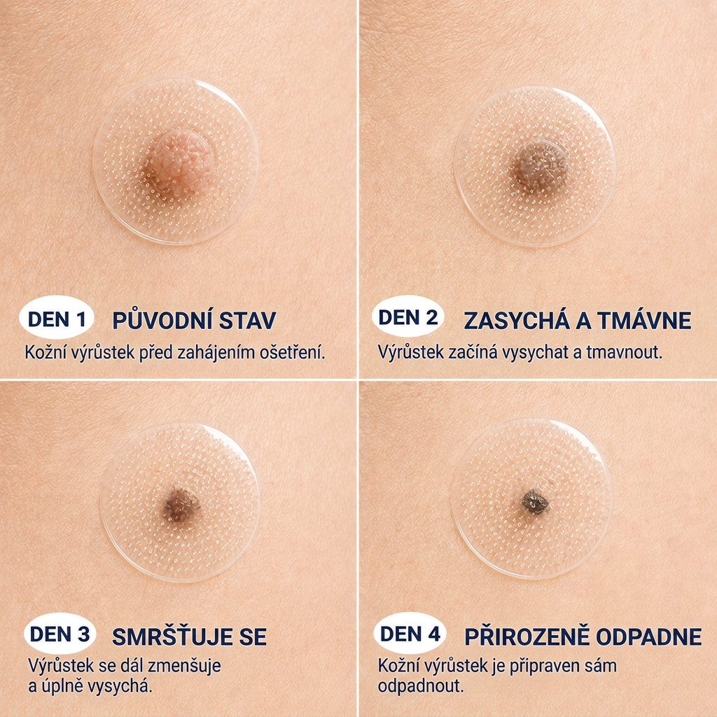 👩‍⚕️🎉 Oficiální obchod | MURWON® 👑 Mikrojehličkové náplasti pro dokonalou pleť a odstranění kožních nedokonalostí (Pro kožní výrůstky, malé kožní útvary, bradavice, mateřská znaménka, stařecké skvrny a pigmentové nepravidelnosti.)