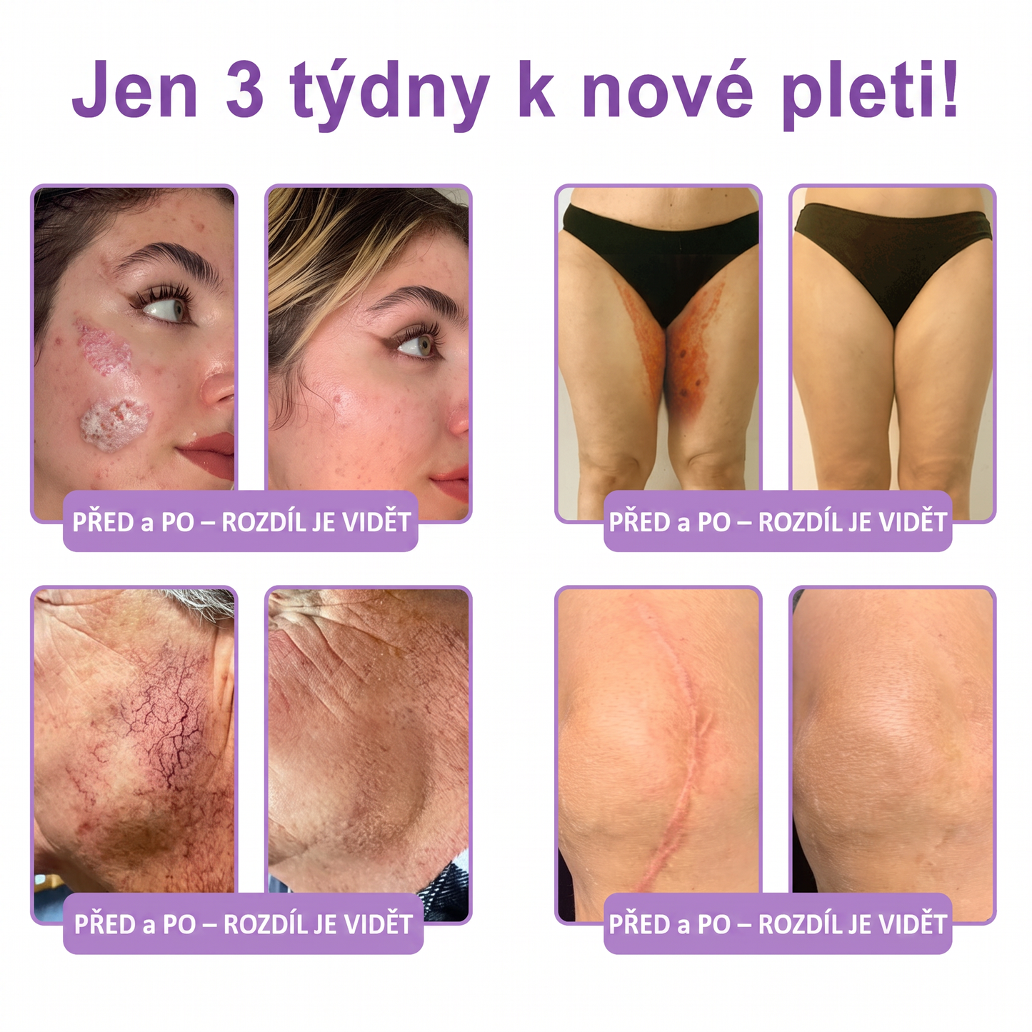 Vitalisys®⭐️PDRN Multi-Peptide Masážní tělový krém s válečkem — proti stárnutí, hydratuje, zpevňuje a liftinguje pokožku, podporuje regeneraci, sjednocuje tón pleti a pečuje o nedokonalosti a tmavé skvrny.